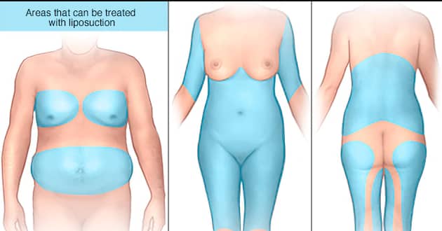 Liposuction Surgery Centre in Brampton